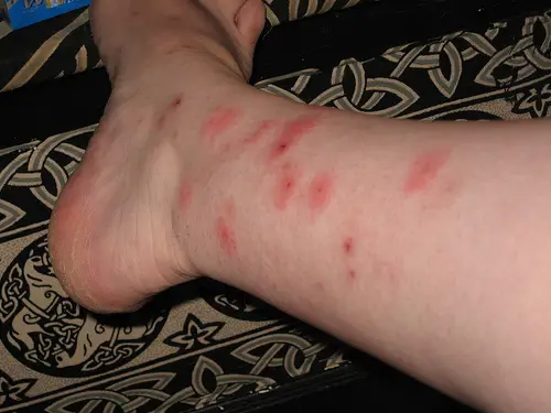 Although Bedbug bites are itchy and very unpleasant, they usually don't cause serious health issues